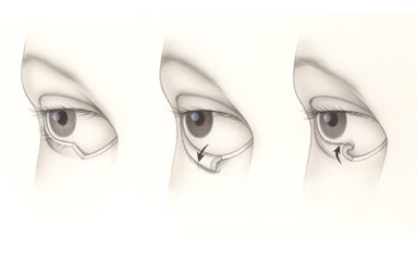 dr-parpados-Sitio-Recons-Eyelid-Malposition-Ectropion