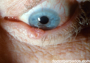 eyelid-cancer1-343x243