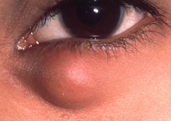 chalazion2-343x243