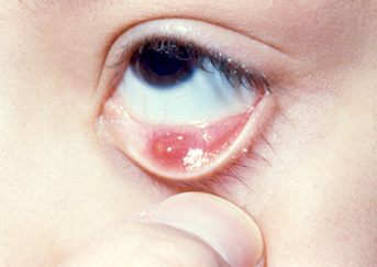 chalazion3-343x243 chalazion3-343x243