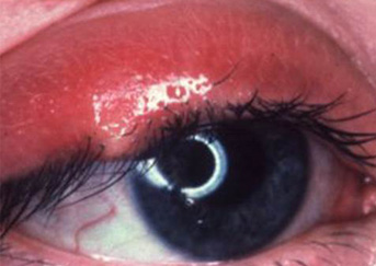 chalazion5-343x243 chalazion5-343x243
