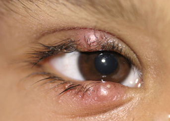 chalazion8-343x243 chalazion8-343x243
