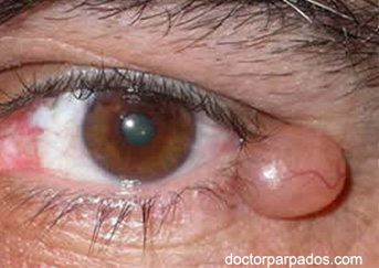 Common Eyelid Lesions - Costa Rica, Surgery, Doctor, Eye, Specialist, Ophthalmologist