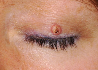 eyelid-wart2-343x243 eyelid-wart2-343x243
