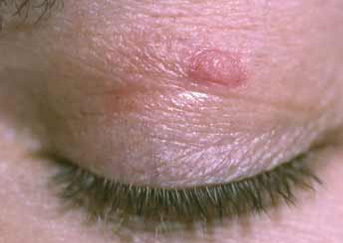 eyelid-wart3-343x243 eyelid-wart3-343x243