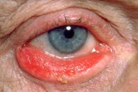 Ectropion is the out-turning of the eyelid.  This causes constant foreign body sensation, tearing and redness of the eye.  Untreated ectropion can cause severe visual consequences. 