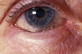 Entropion is the in-turning of the lower eyelid.  This causes constant eye irritation, redness and tearing.  If not treated properly, eye sight could be in danger.